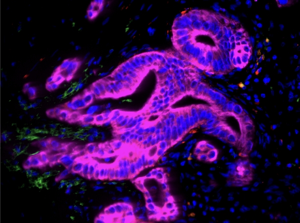 Human PDAC IF 대표이미지